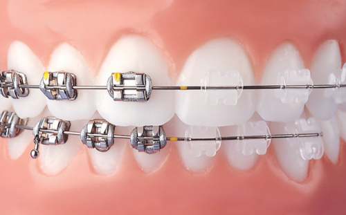 Ceramic Braces - Advanced Orthodontics