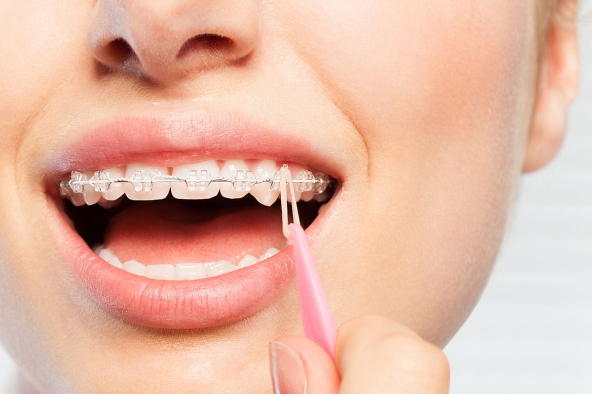 How Much Do Adult Braces Cost In Canton Mi Blog